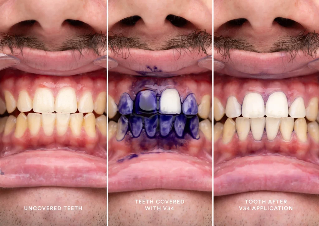 Como funciona el blanqueamiento dental en casa aplicado a los dientes